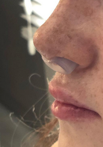 Post-Rhinoplasty Nasal Retainer